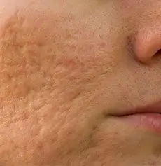 Acne scars