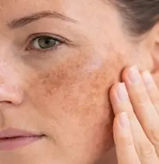 Hyperpigmentation