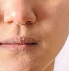 Dry Skin