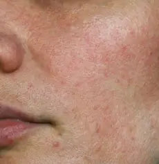Skin Blemishes